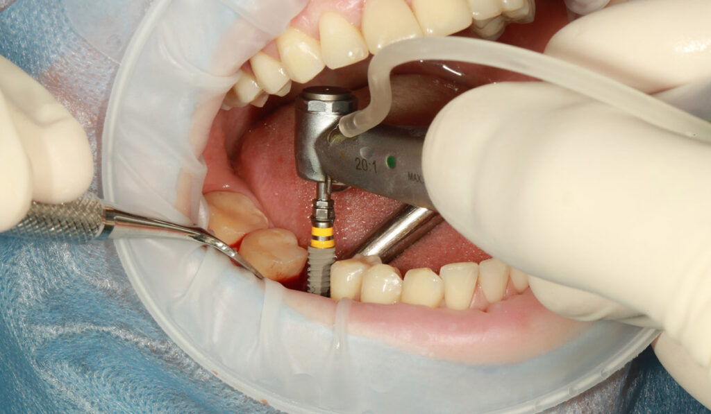 Why are Dental Implants so Important