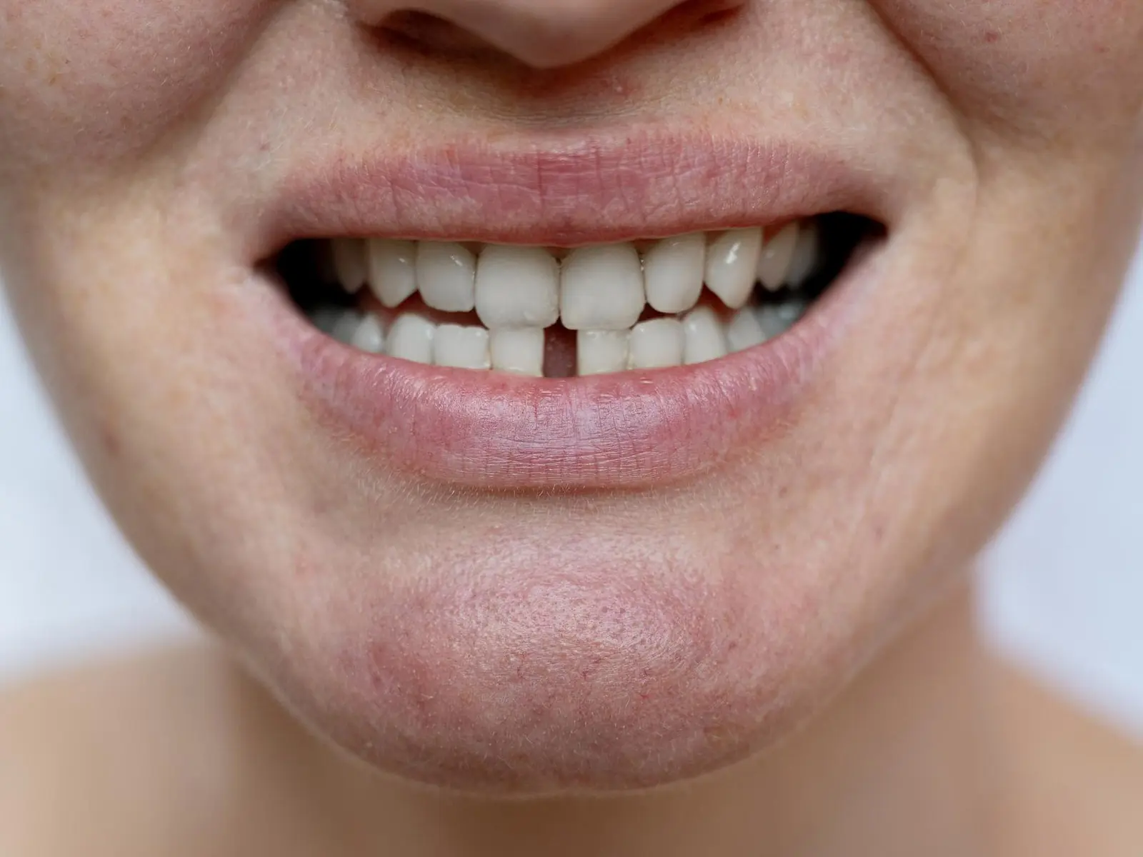missing-teeth-dental-clinic