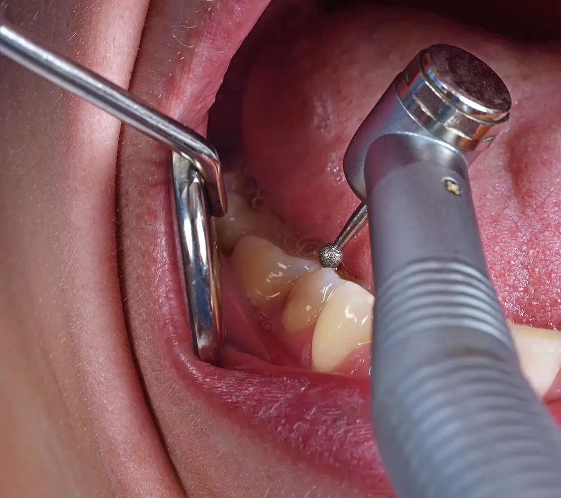 root-canal-treatment-london-dental-clinic